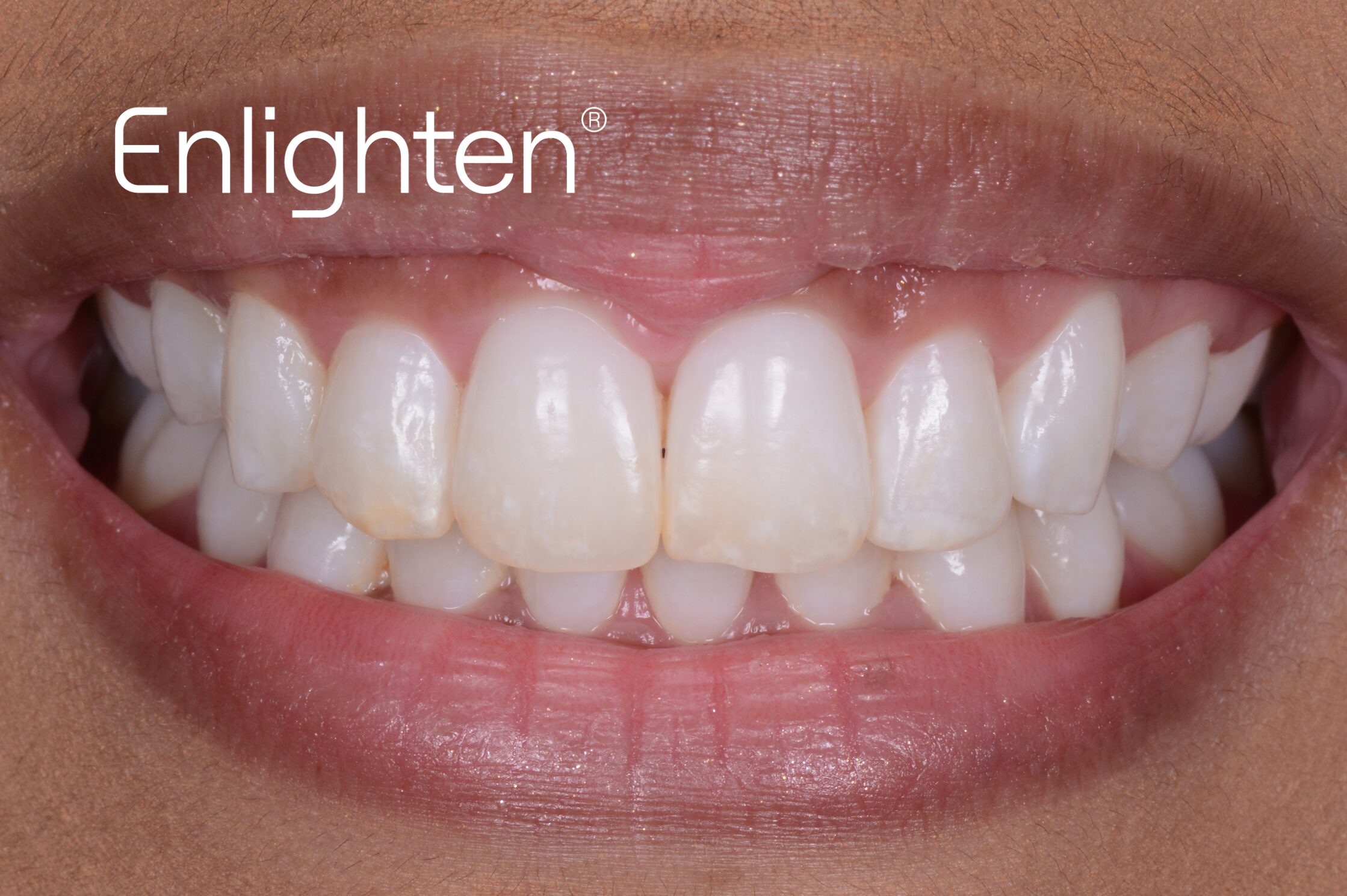 Teeth whitening results - after treatment case 1