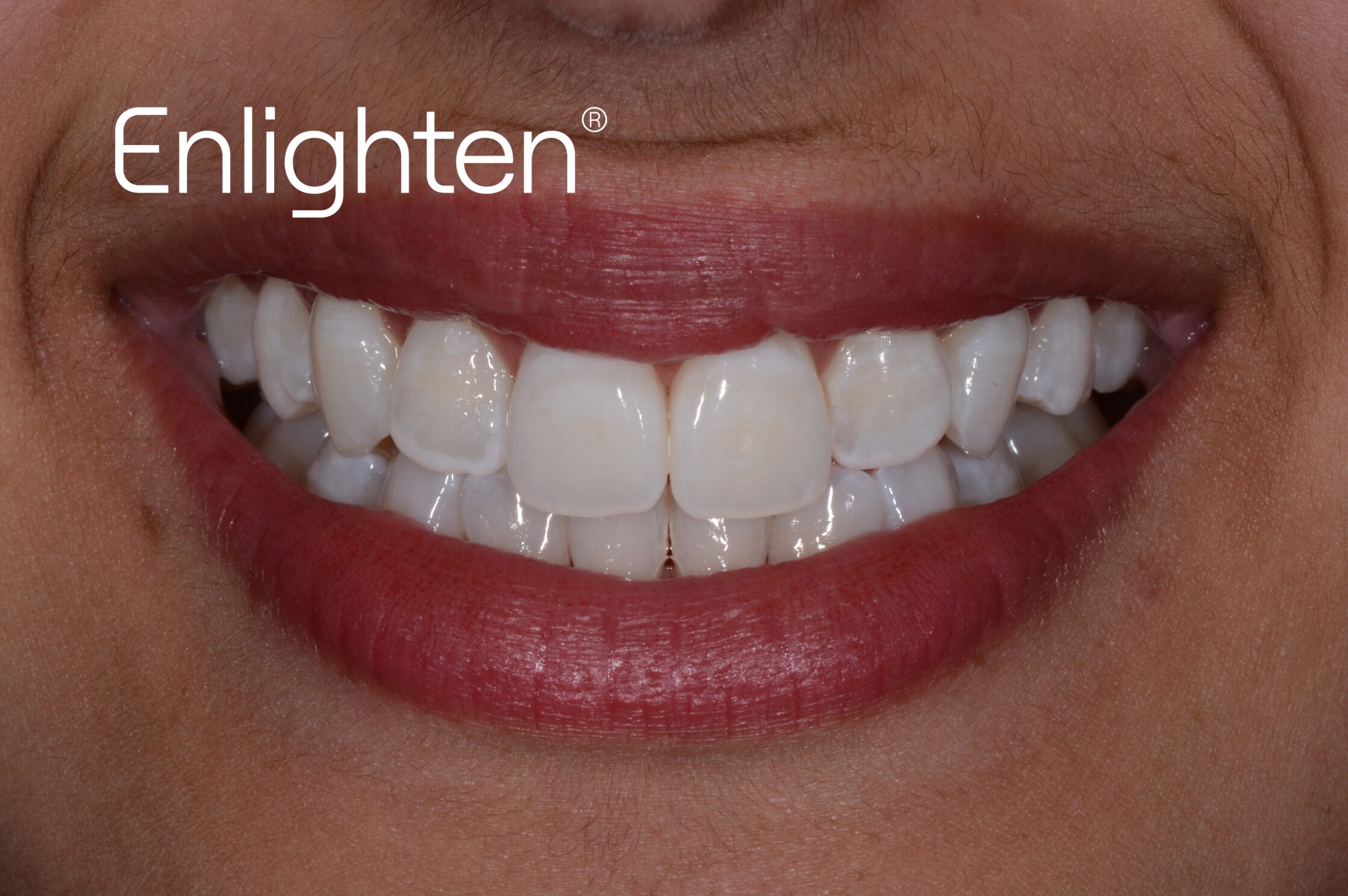 Teeth whitening results - after treatment case 4