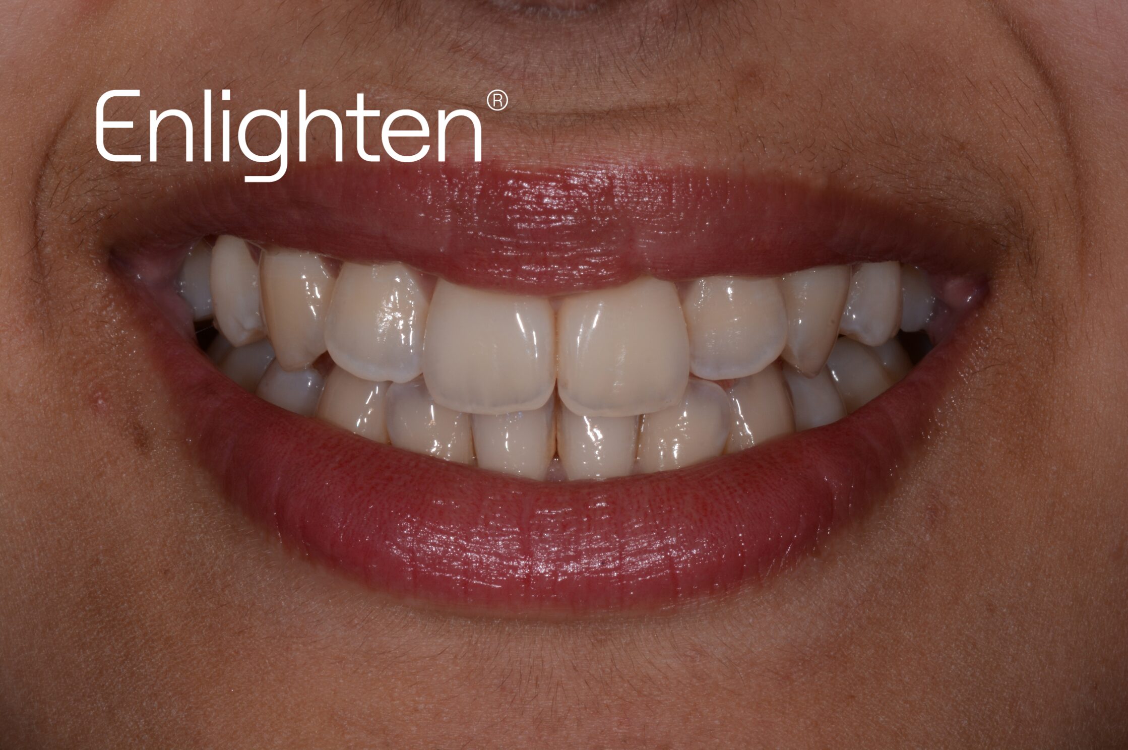 Teeth whitening before treatment case 4